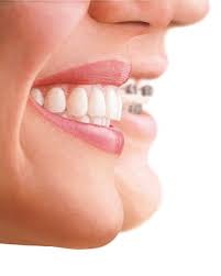 Watch the video explanation about correcting a severe overbite or overjet online, article, story, explanation, suggestion, youtube. Can Invisalign Fix Protruding Front Teeth
