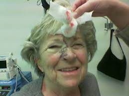 Mom and Her Re-built Nose