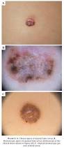Image result for Spitz Nevus