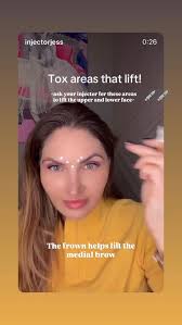 Love me some biostim to the temples 😍 . ——————————————————- BOOK WITH  US👇🏻👇🏻👇🏻 FORTE FACES INC. 📱 267-638-5361 📧 Info@fortefaces.com 🧷  Booking link in bio ——————————————————- Sara McLaughlin BSN, RN  @sara.mclaughlin.injector •