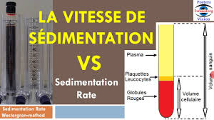 La vitesse de sédimentation est un test qui mesure le taux de sédimentation, ou chute libre des globules rouges (hématies) dans un échantillon de sang laissé dans un tube vertical, au bout d'une heure. Methode Mesure De La Vitesse De Sedimentation Rate Vs Esr Youtube