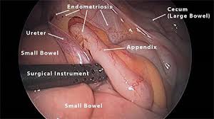 The type of symptoms and their severity are likely to be related to the location of the endometrial tissue rather. Endometriosis The Appendix Bloomin Uterus