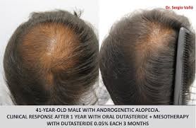 Hereditary hair loss with age is the most common cause of baldness. Dutasteride And Minoxidil Before And After Photos Hair Loss Cure 2020