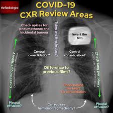 A collection of data interpretation guides to help you learn how to interpret various laboratory and radiology investigations. Theradiologist Auf Twitter Some Thoughts On Chest X Ray Interpretation In The Covid Era Thread