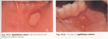 Image result for Canker sores symptoms roof of the mouth
