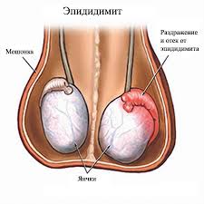 Symptoms may include a lump in the testicle, or swelling or pain in the scrotum. Testicular Cancer Doc Dr Ural Oguz