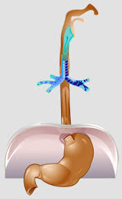 Speiserohrenoperation In Munchen Chir Med Tum De