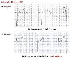 Lqt3 Patient Aged 17 Yrs Major Qtc Prolongation Qtc 516 Ms Not Download Scientific Diagram