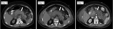 Invasive infection due to candida species is largely a condition associated with medical progress, and is widely recognized as a major cause of morbidity and mortality in the healthcare environment. Acute Pancreatitis Update On Management The Medical Journal Of Australia