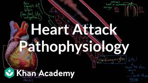 Heart Attack Myocardial Infarction Pathophysiology Video