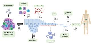 In theory, prostate cancer cells can spread anywhere in the body. Cancers Free Full Text Inflammation As A Driver Of Prostate Cancer Metastasis And Therapeutic Resistance