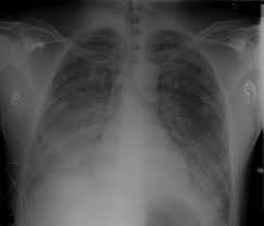 The condition causes fluid to accumulate in the lungs, which in turn reduces blood oxygen to dangerously low levels. Acute Respiratory Distress Syndrome Amboss