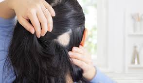 女性の円形脱毛症の原因と治す方法、治るまでの隠し方は？