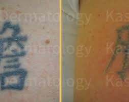 Looking for tattoo removal providers in dallas, tx? Laser Tattoo Removal Dallas Best Laser Tattoo Removal In Dallas Tx