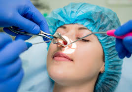 Functional endoscopic sinus surgery FESS