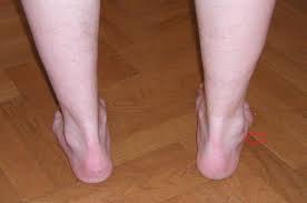 Hallux Valgus Dr Michael Vitek 1120 Wien