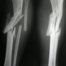 Spiral fracture — sagittarius a star 03:25. Creafect Pvlsar Spiral Fracture One Drop Preview By Pvlslr Fracture Healing Bone Fracture Comminuted Fracture