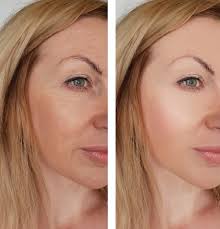 The right way to treat sagging neck and jowls. Sagging Jowls Glasgow Causes Treatment For Jowls Este Medical Group