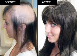 Non Surgical Hair Replacement Clinic Dubai Hair Replacement Hair Replacement Systems Hair System