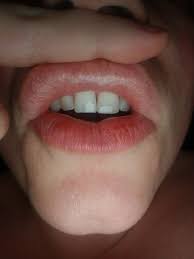 White spots on lips pictures. Am I Having Some Kind Of Reaction To The Juvederm Injected In My Lips Photo