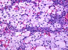 Jun 18, 2021 · the u.s. Webpathology Com A Collection Of Surgical Pathology Images
