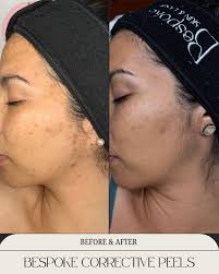 Incredible results achieved with our Bright & Tone Laser Peel treatment⚡️!  This advanced laser rejuvenating treatment combines 3 techniques using our  Lutronic Clarity platform: ・Alex Toning