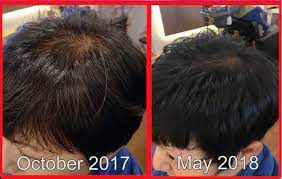 When can i wash my hair after rebonding? Hair Loss After Rebonding Side Effects Treatment For Damaged Rebonding Hair Bee Choo Ladies