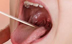 Image result for gum cancer symptoms