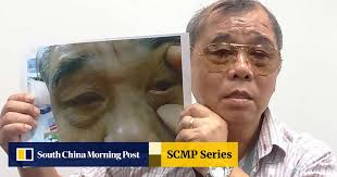 How could doctors forget to remove my sutures? Cataract patient has  surgical thread stuck in eye for two years