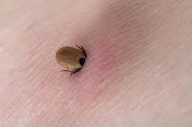 What Is The Best Way To Remove A Tick Top 3 Tick Removal Tools Ticks Tick Removal Removal Tool