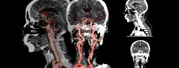 The internal carotid artery (latin: Ct Angiography Head And Neck