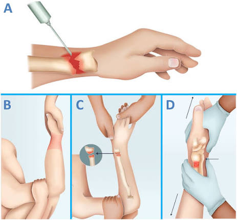 Conservative treatment of distal radius fractures: An abandoned art | Revista Española de Cirugía Ortopédica y Traumatología