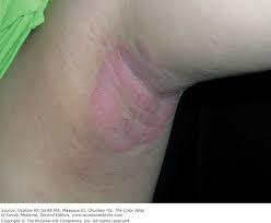 Image result for Erythrasma