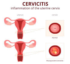 Displazia de col uterin poate fi de trei tipuri în dependenţă de profunzimea afecţiunii Cervicita Simptome Si Tratament