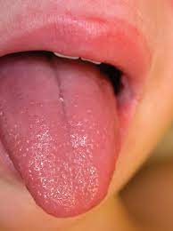 Check spelling or type a new query. A Girl With A Sore Throat Fever And Strawberry Tongue Consultant360