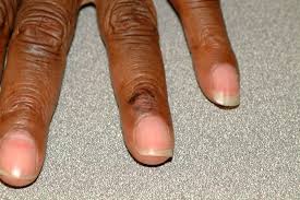 These and other types of skin cancers can also look different from the descriptions above. Skin Cancer Photo Gallery