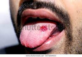 Un Cierre De Una Lengua Enferma Foto De Stock Editar Ahora 1671064615