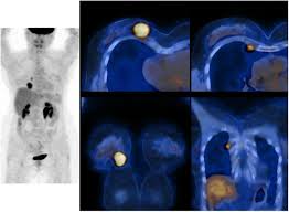 Inflammatory breast cancer is usually treated with chemotherapy first (called neoadjuvant. 18f Fdg Pet Ct For Staging And Restaging Of Breast Cancer Journal Of Nuclear Medicine