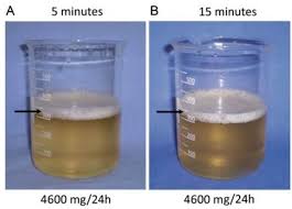 Image result for Isolated Proteinuria