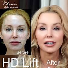It’s now been two and a half years now since Darnell Cox @liveyoungdarnell  experienced the advantage that the HD Lift™️ has over fillers and other  more short-term efforts. She has NO filler and NO ...