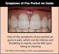 Gum Abscess Gum Boil Gum Young Living Oils Recipes Living Oils Recipes