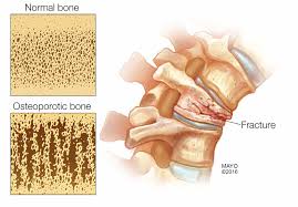 womens wellness bone density in women mayo clinic news