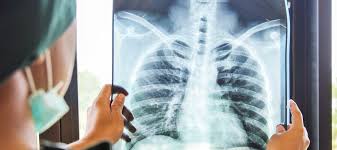 Tuberculosis Una Enfermedad Que Aun No Esta Erradicada