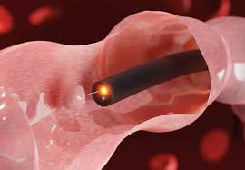 Image result for Colonic Polyp