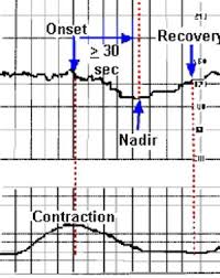 Image result for Late Deceleration