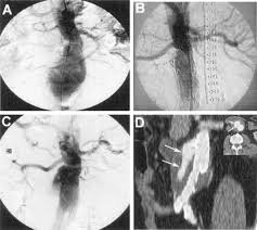 Plasma Levels of Metalloproteinases-3 and -9 as Markers of Successful  Abdominal Aortic Aneurysm Exclusion After Endovascular Graft Treatment