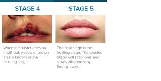 The hottest person alive is awake and ready for some morning fun! Cold Sore Stages Identification And Treatment