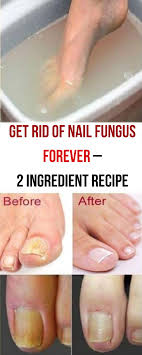 A Fungal Nail Occurs When A Fungus Attacks A Toenail A Fingernail Or The Skin Under The Nail Any Toenail Fungus Remedies Natural Healing Remedies Nail Fungus