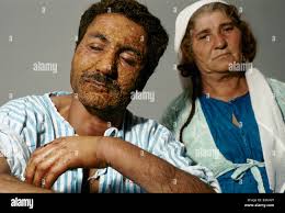 Severely burned hi-res stock photography and images