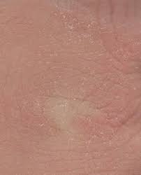 Xerosis is the medical term used to describe excessively dry skin. Xeroderma Wikipedia